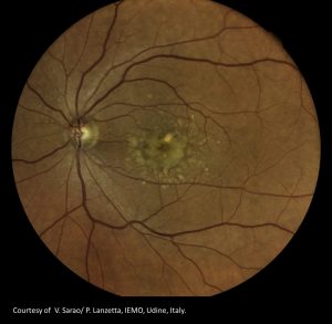 Dry-Age-related-Macular-Degeneration-